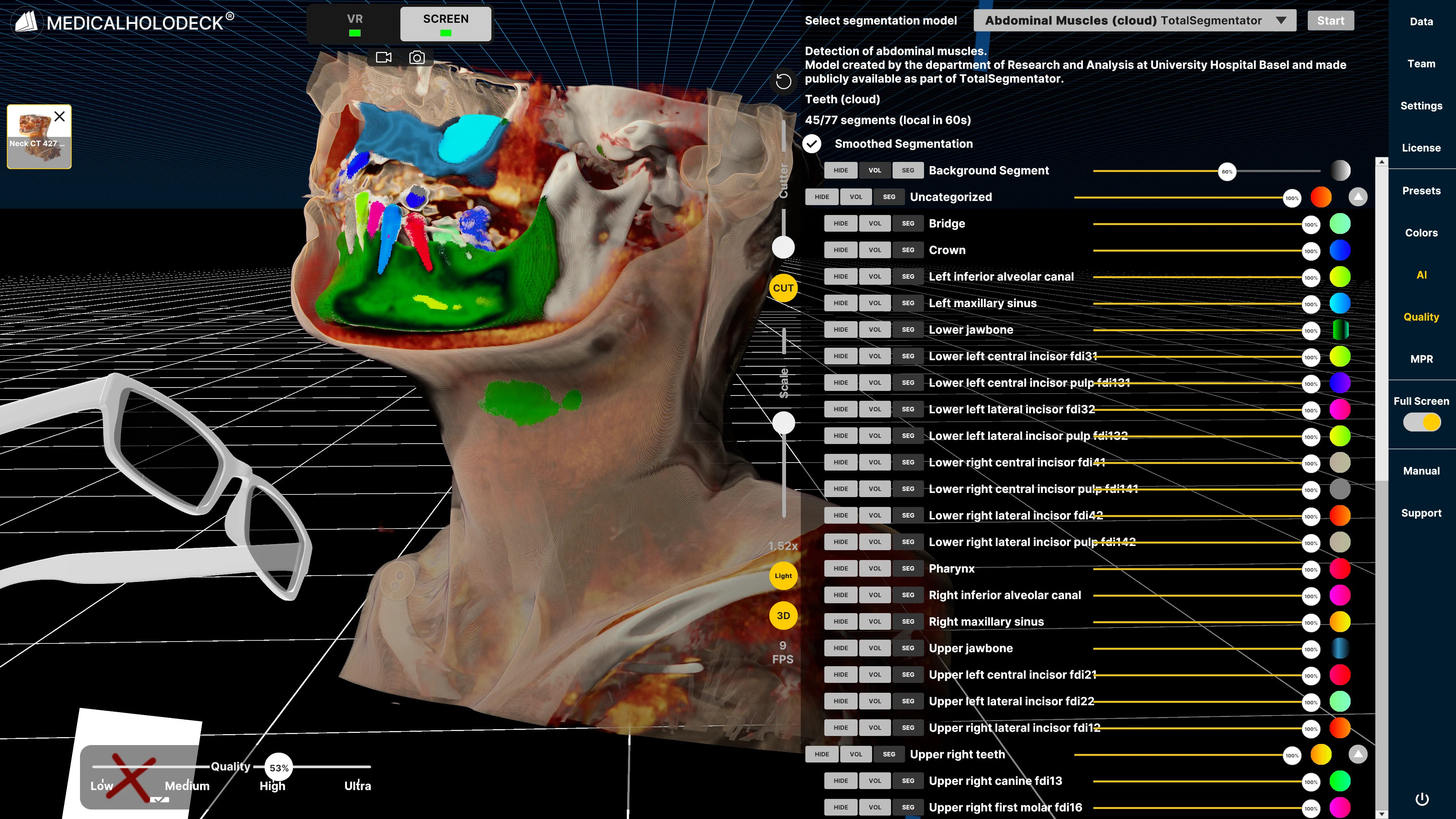 Medicalholodeck segmentation workspace showing abdominal structures and model controls.