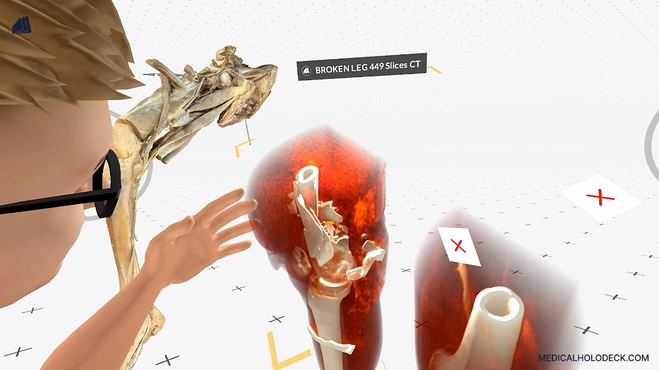 A virtual introduction into knee fractures thumbnail 1