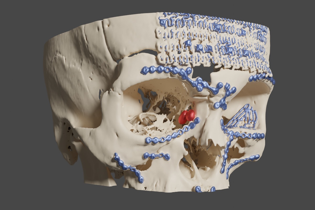 Virtual reality in endoscopic dacryocystorhinostomy