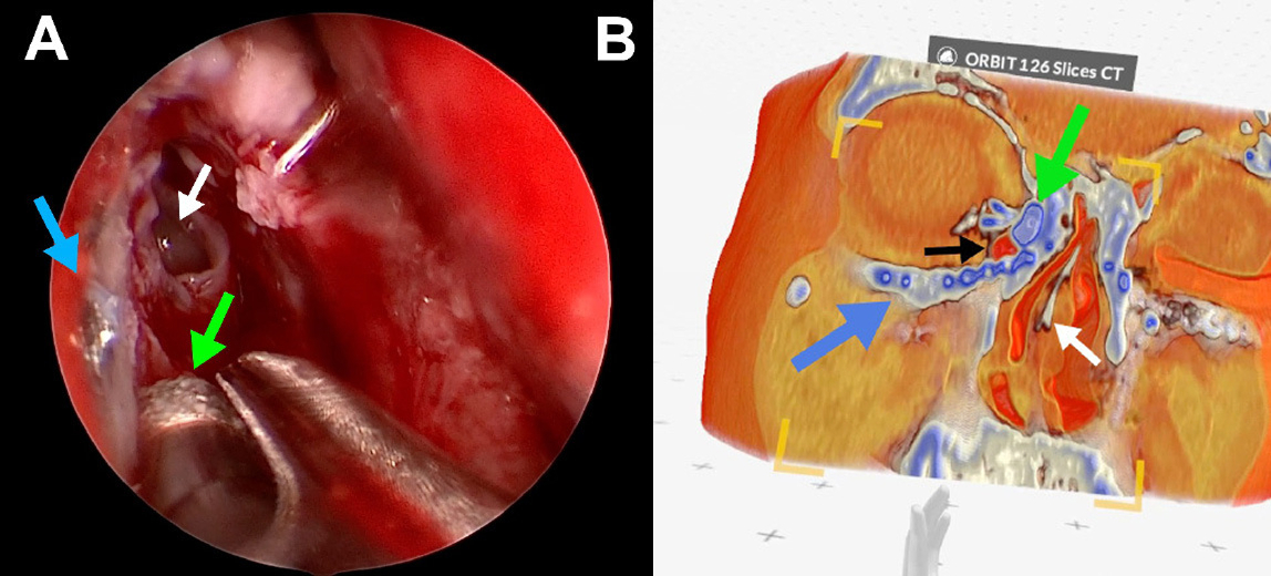 Spatial imaging in complex tear duct surgery