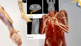 How extended reality is transforming orthopedics
